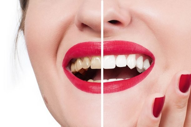 Teeth-Whitening-in-Pembroke-Pines-p